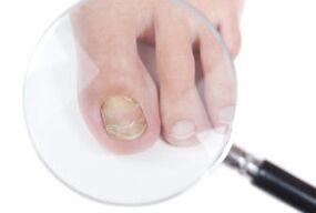 Causas de fungo das unhas