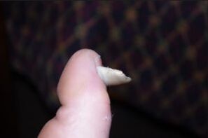 Sintomas de fungo nas unhas