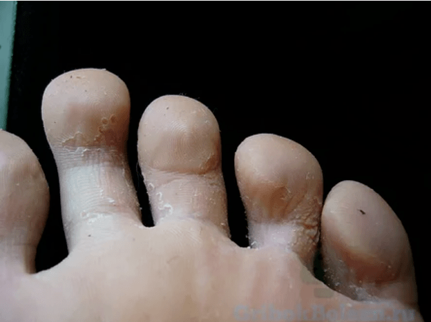 Os estágios do fungo