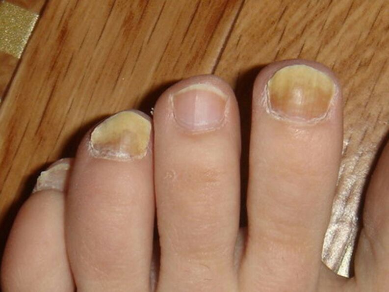 infecção fúngica das unhas dos pés